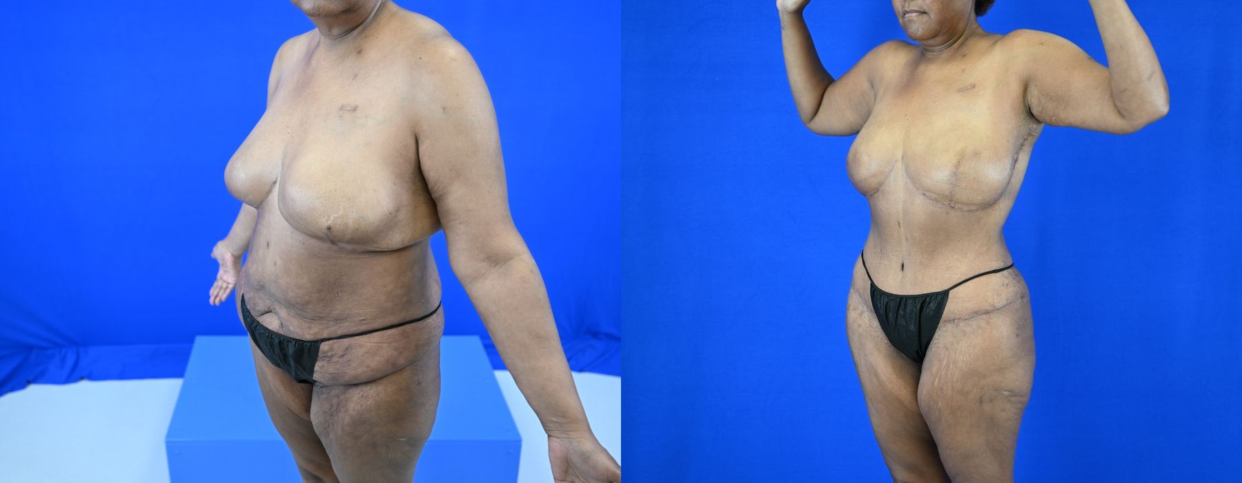 Implant Exchange - Thumbnail 2