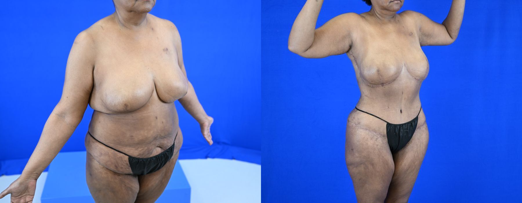 Implant Exchange - Thumbnail 3