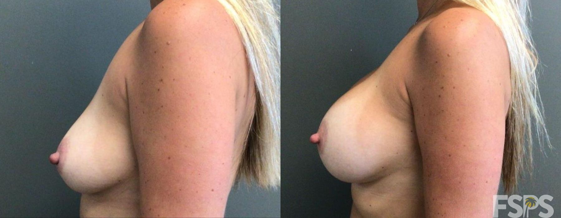 Breast Augmentation - Thumbnail 2