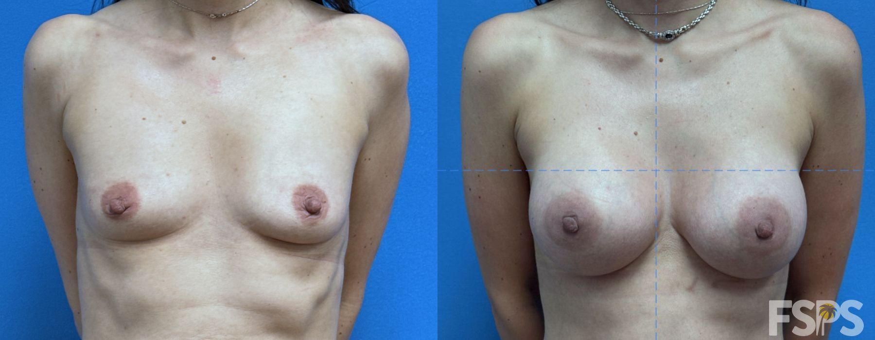 Breast Augmentation - Case 22948