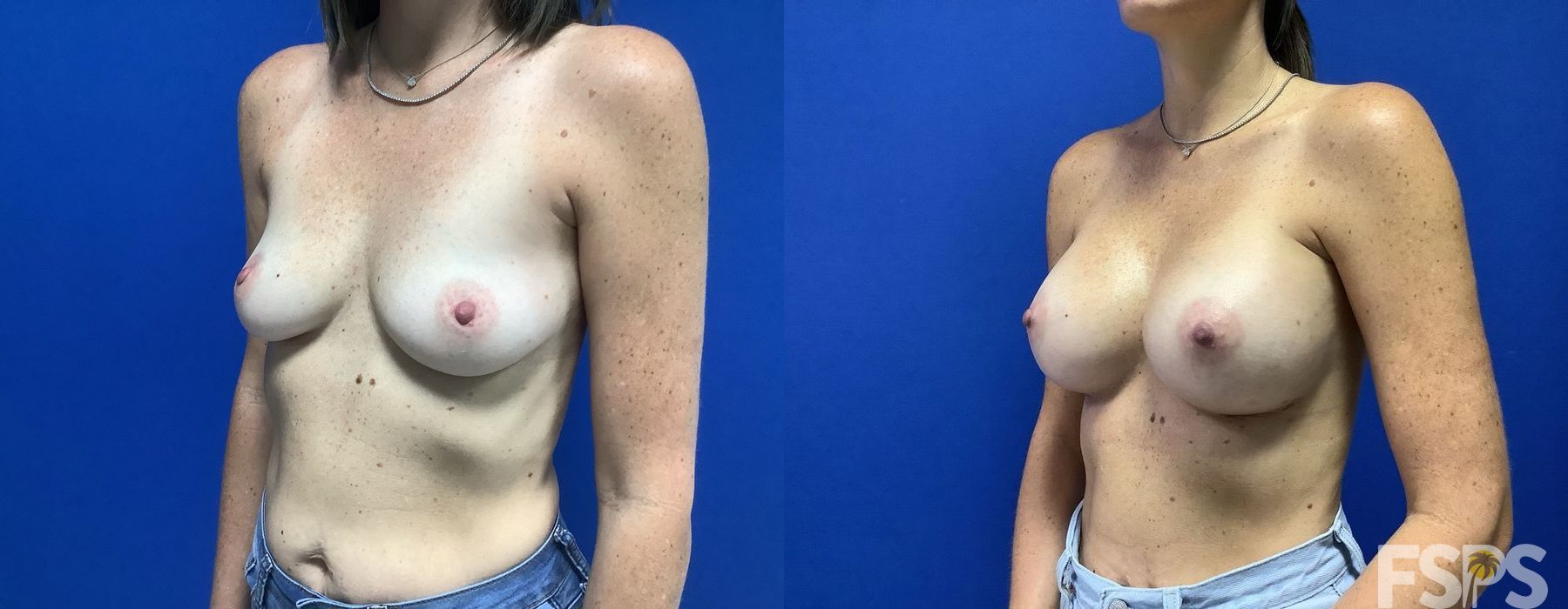 Breast Augmentation - Case 22772