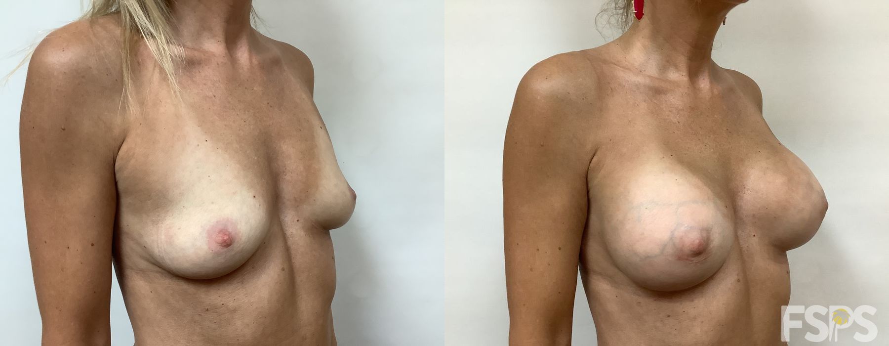 Breast Augmentation - Thumbnail 3