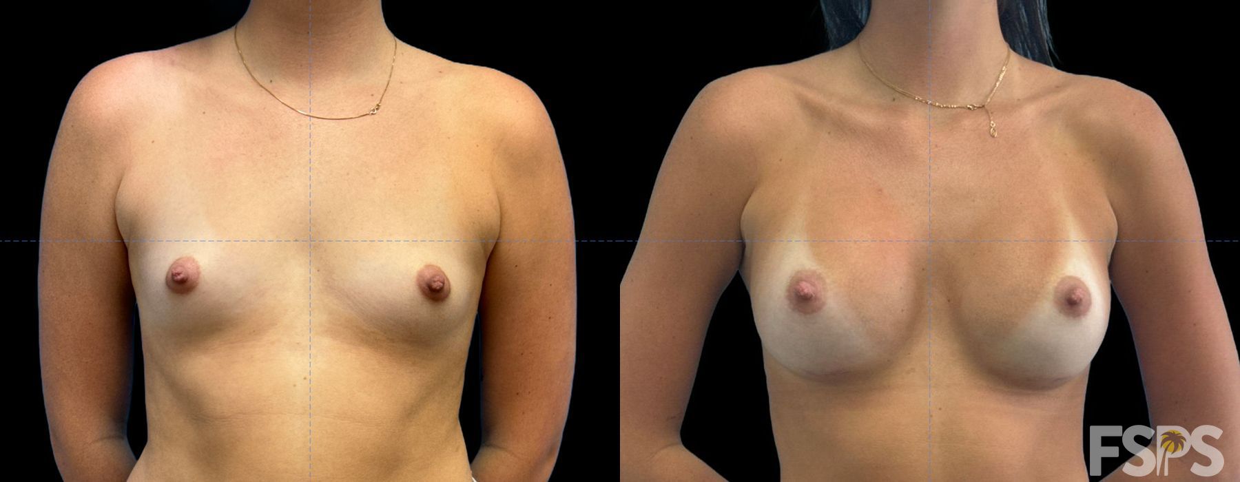Breast Augmentation - Case 22886