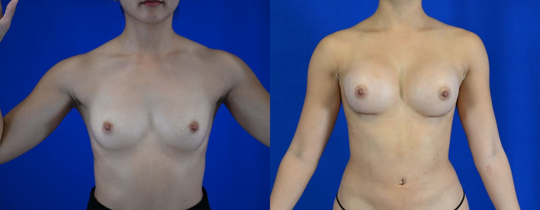 Breast Augmentation - Case 22883