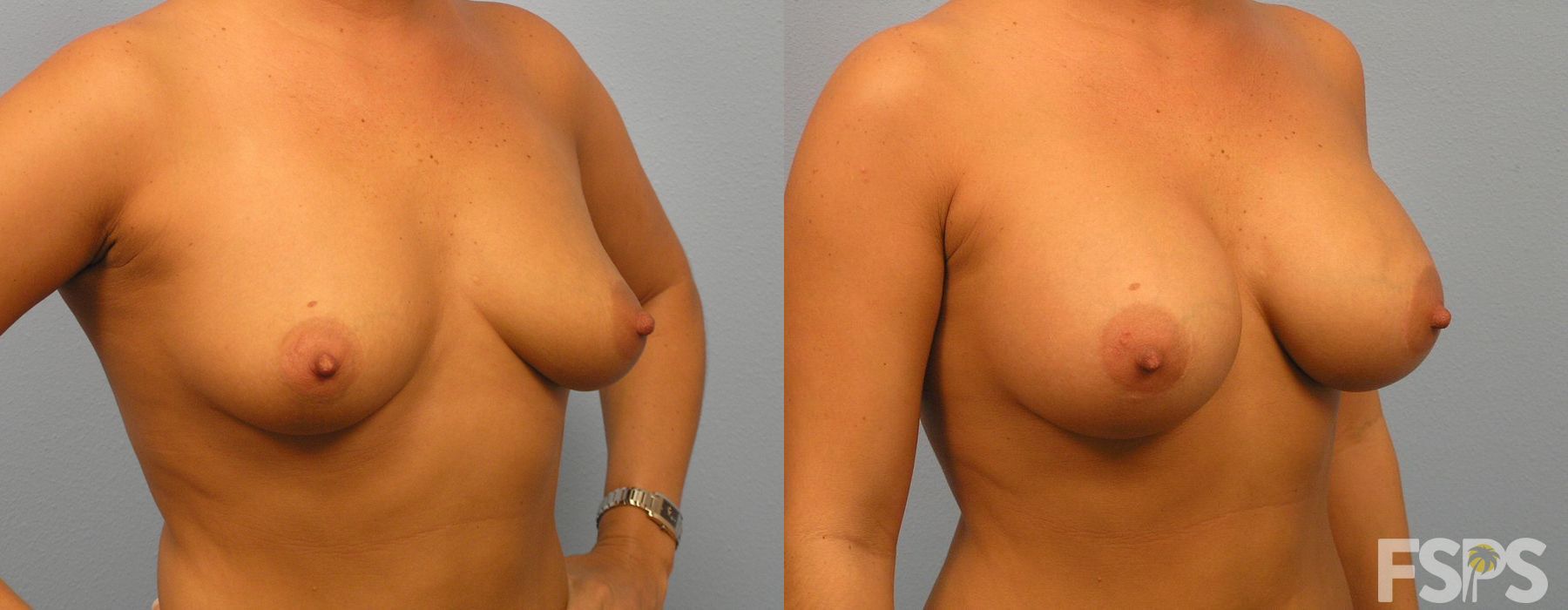 Breast Augmentation - Thumbnail 2
