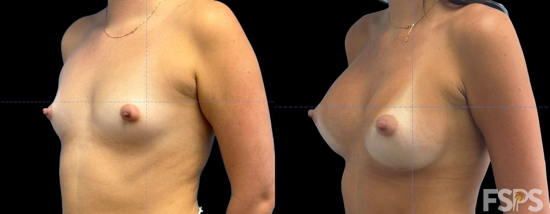 Breast Augmentation - Thumbnail 2