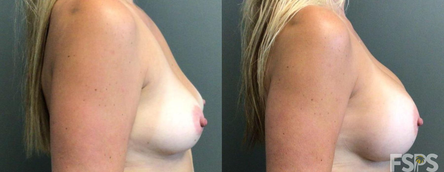 Breast Augmentation - Thumbnail 3