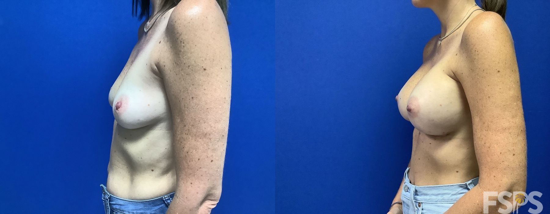 Breast Augmentation - Thumbnail 3