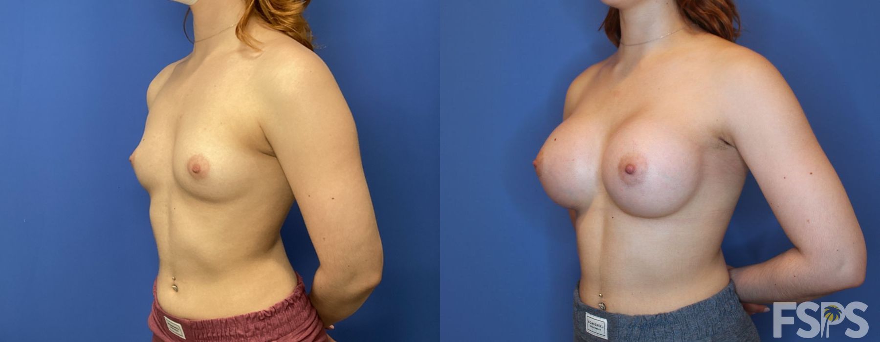 Before and after Breast Augmentation case 17618 - Angle 4