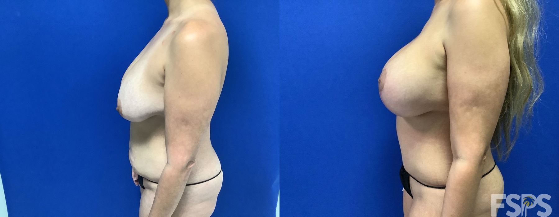 Breast Augmentation with Lift - Thumbnail 3