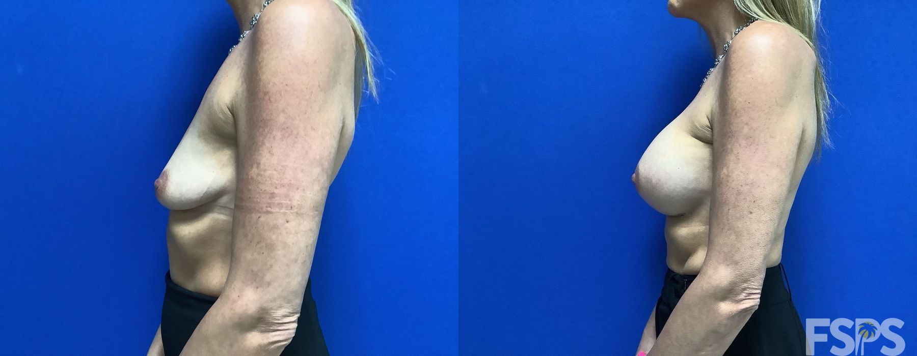 Breast Augmentation - Thumbnail 3