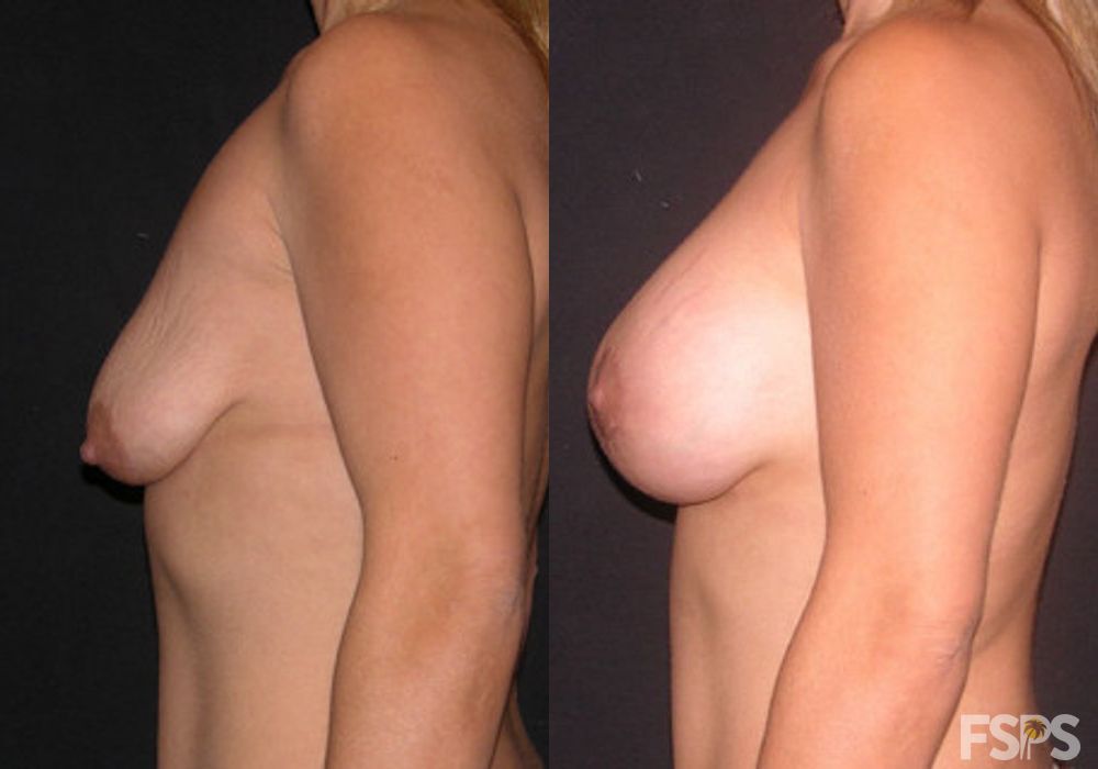 Breast Lift - Case 22793