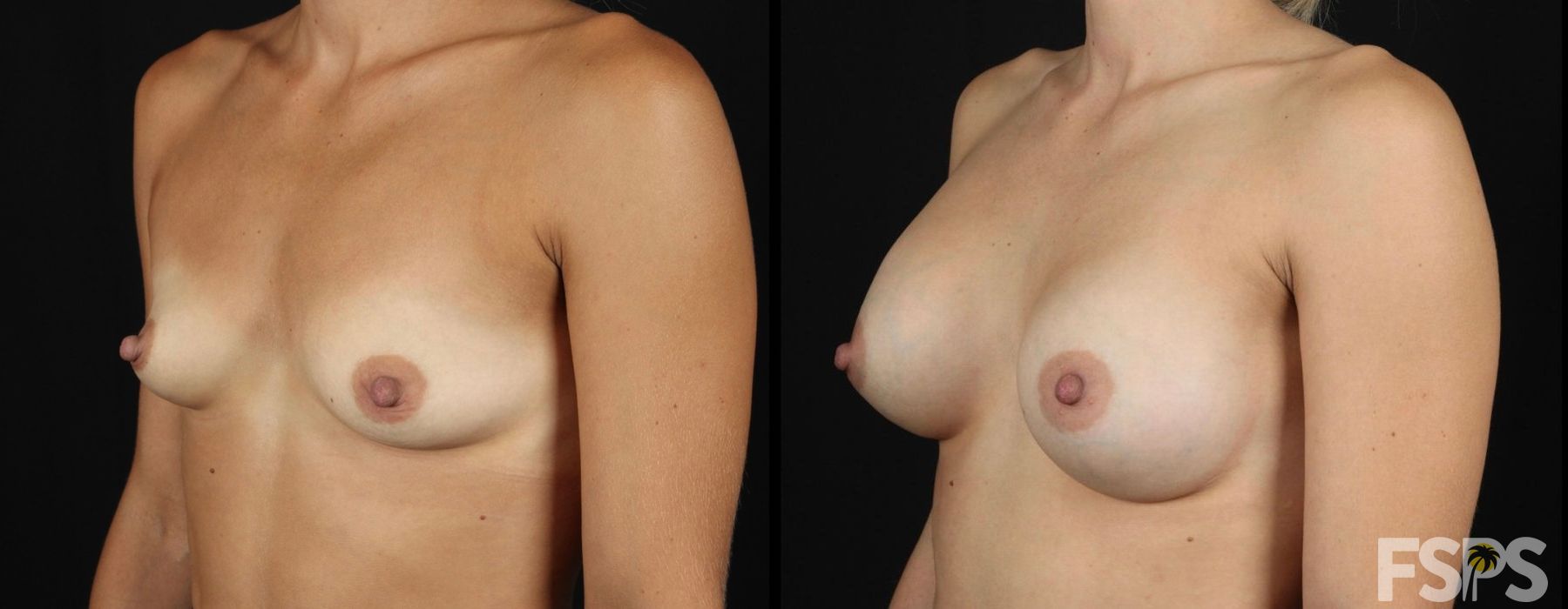 Breast Augmentation - Case 22776