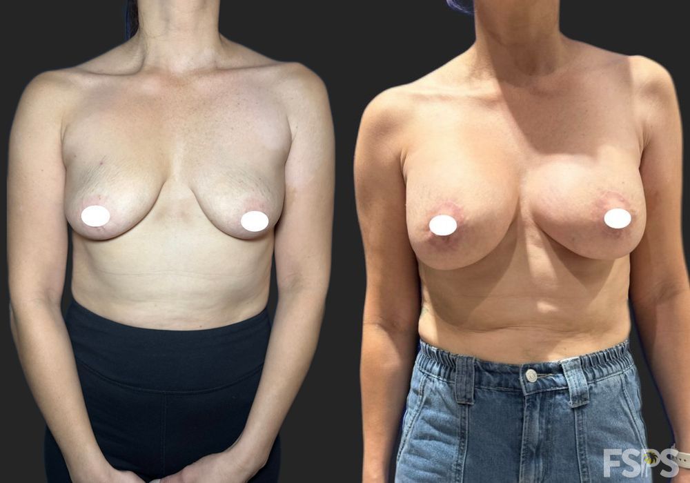 Breast Lift - Case 22953