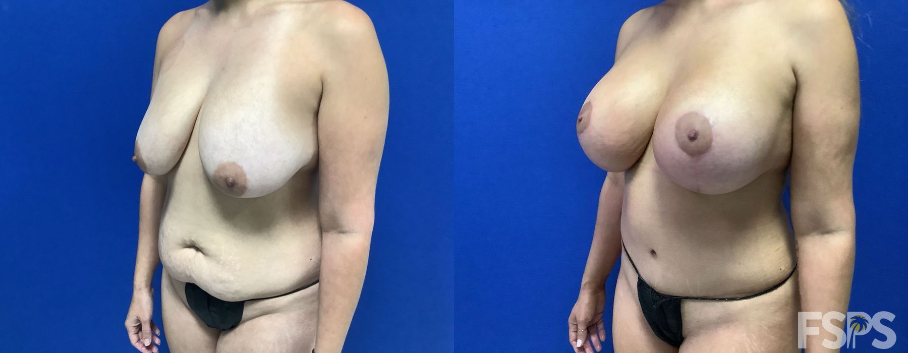 Tummy Tuck - Case 22755