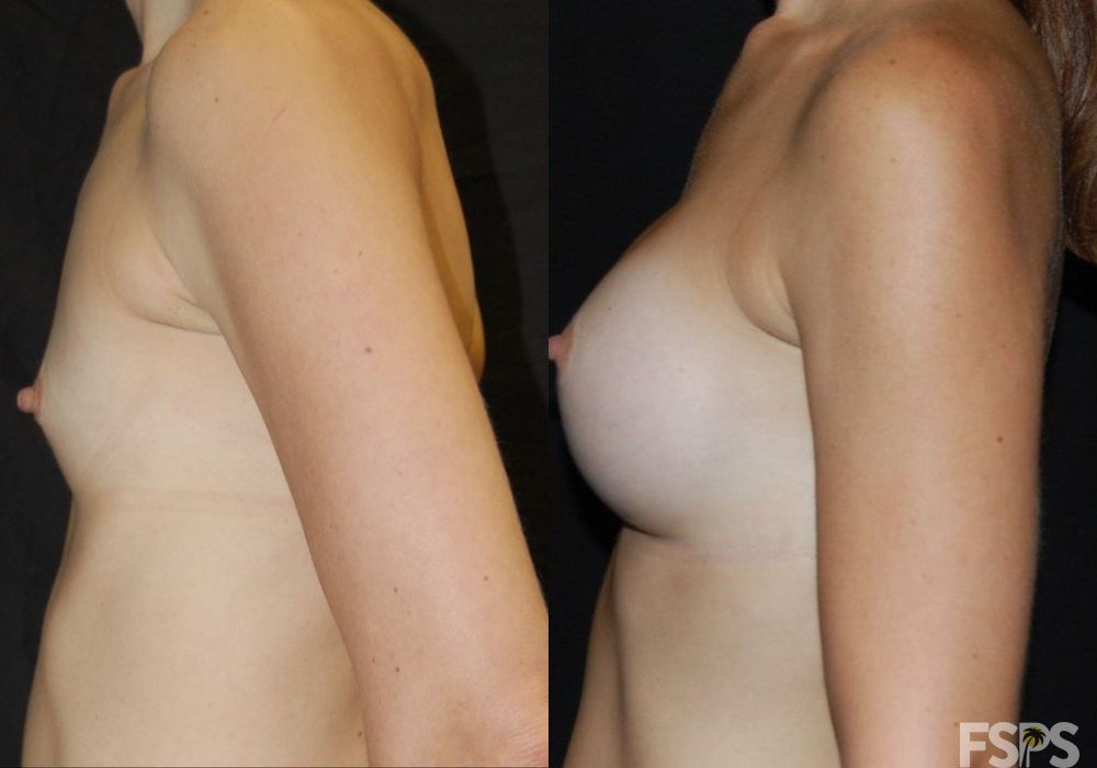 Breast Augmentation - Thumbnail 3