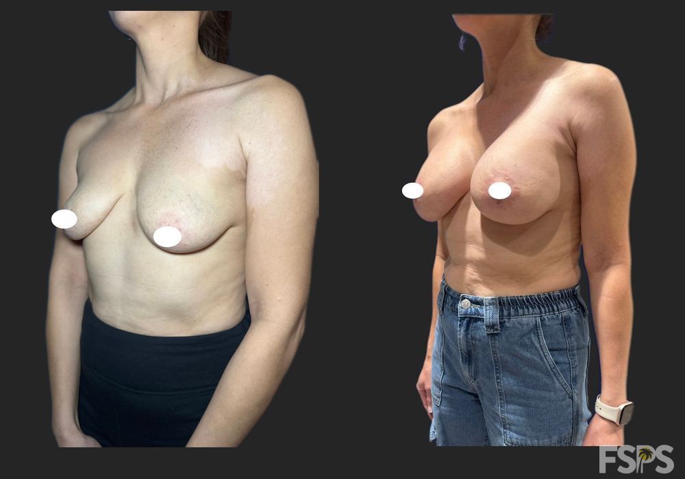 Breast Lift - Thumbnail 2
