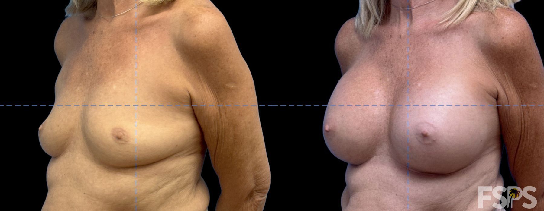 Breast Augmentation - Thumbnail 2