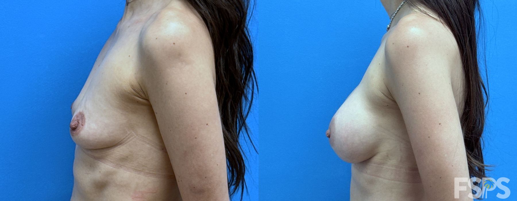 Breast Augmentation - Thumbnail 2