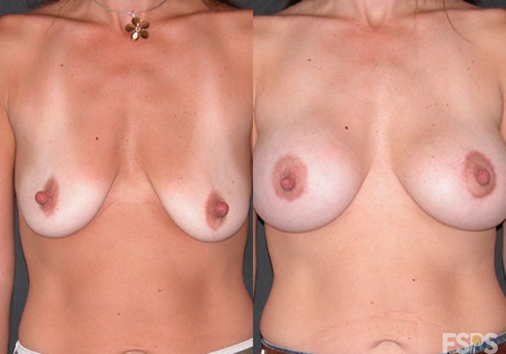 Breast Augmentation with Lift - Case 22657