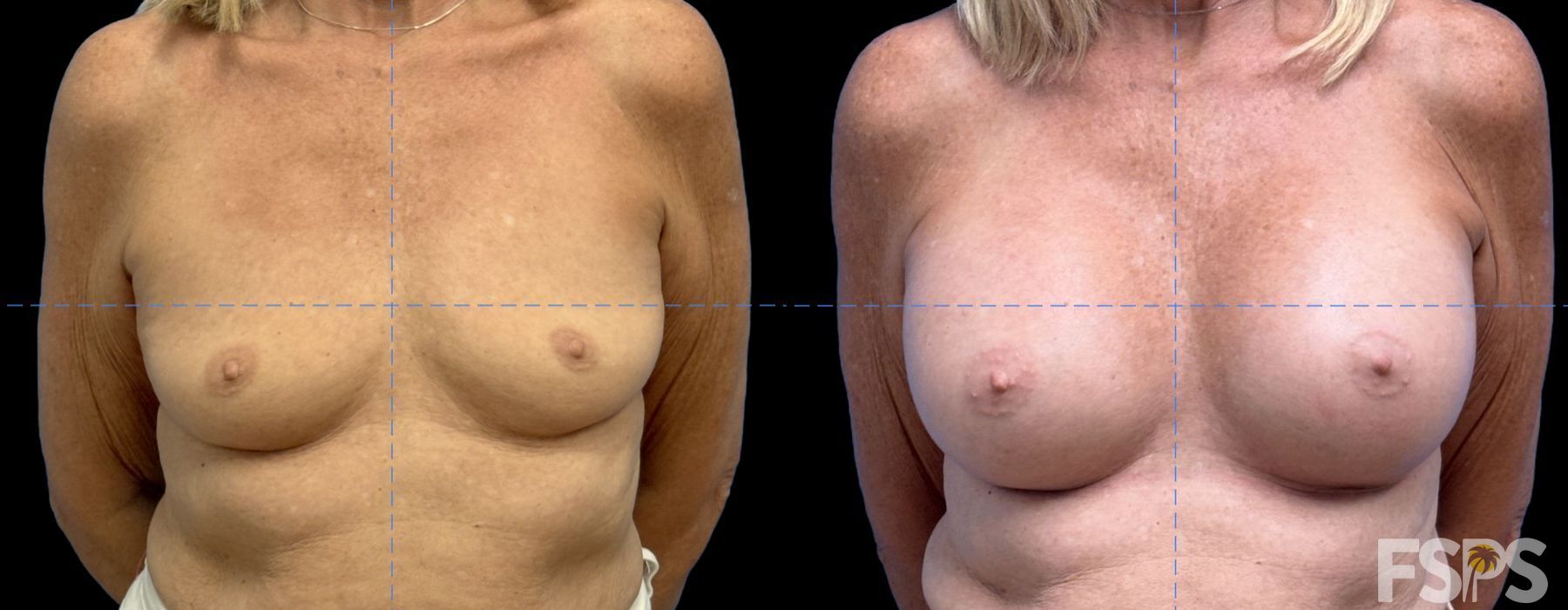 Breast Augmentation - Case 22885