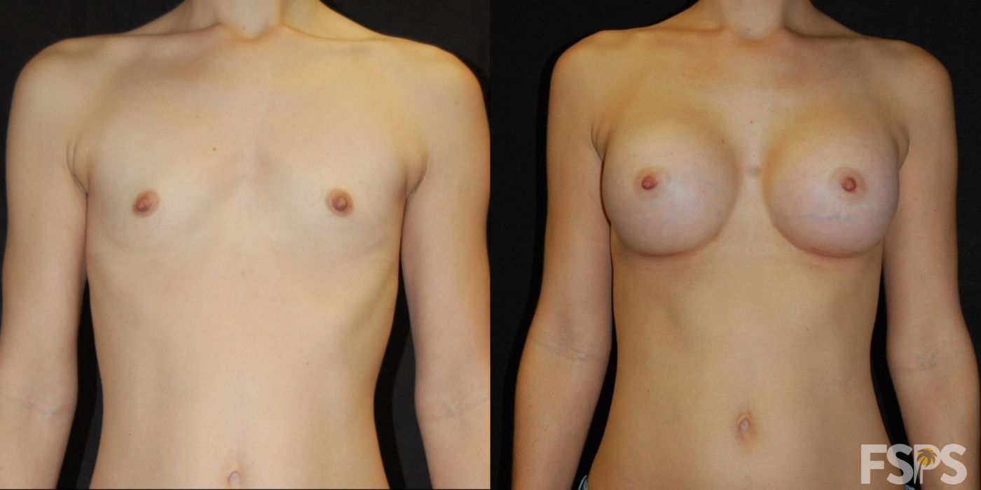 Breast Augmentation - Case 22768