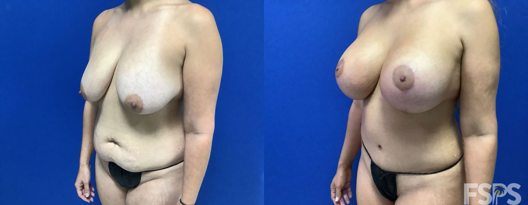 Breast Augmentation with Lift - Thumbnail 2