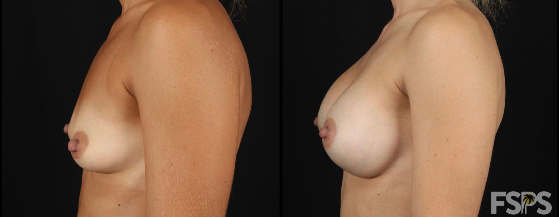 Breast Augmentation - Thumbnail 3