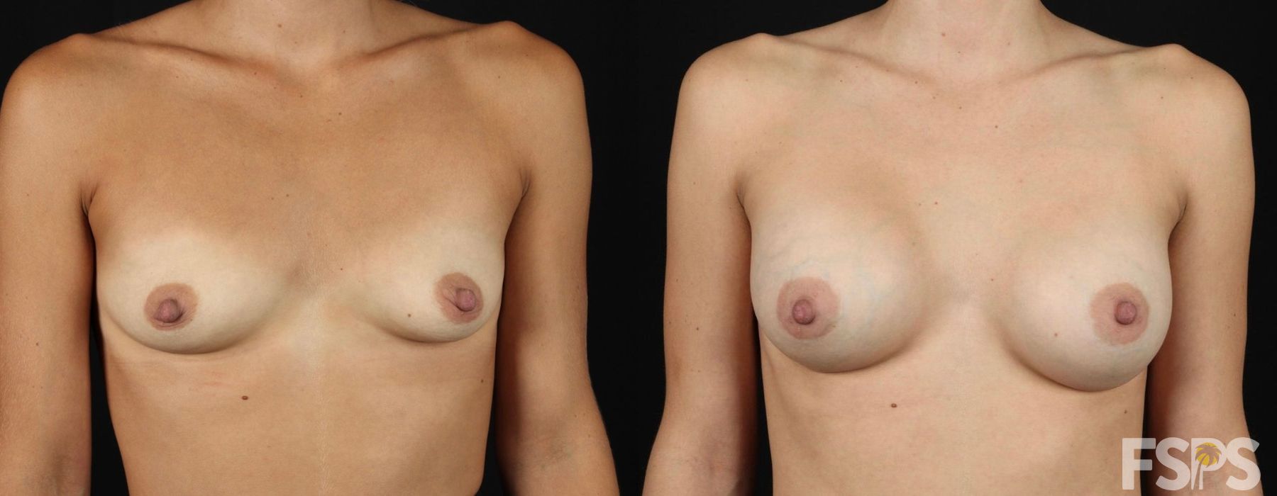 Breast Augmentation - Thumbnail 2