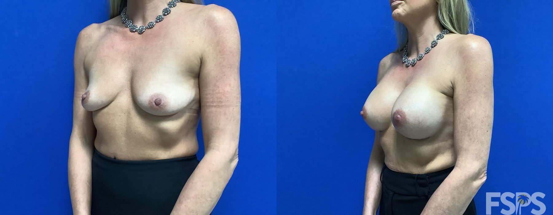 Breast Augmentation - Case 22775