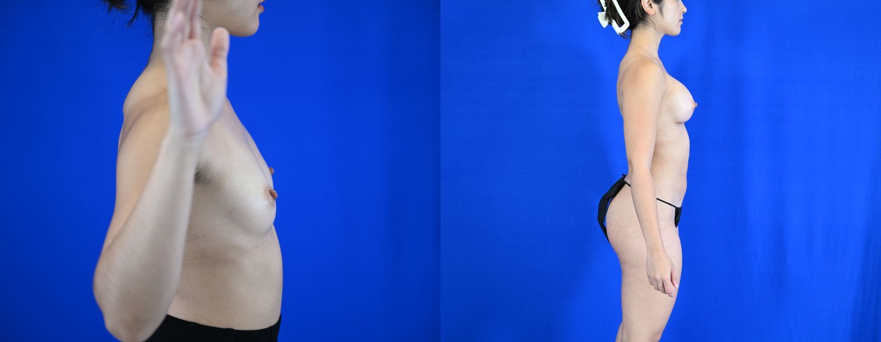 Breast Augmentation - Thumbnail 5