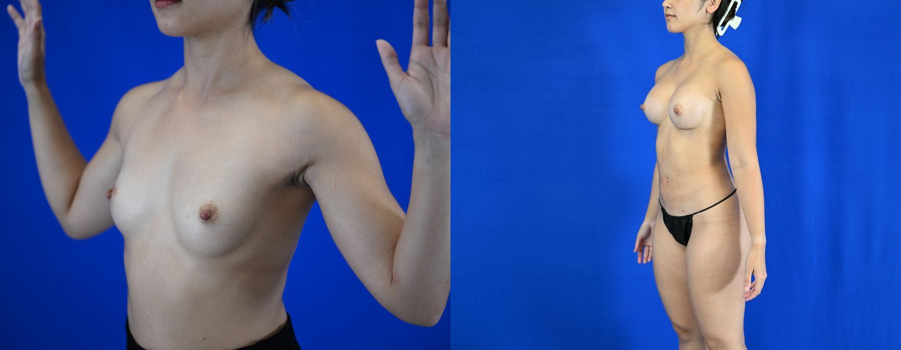 Breast Augmentation - Thumbnail 2