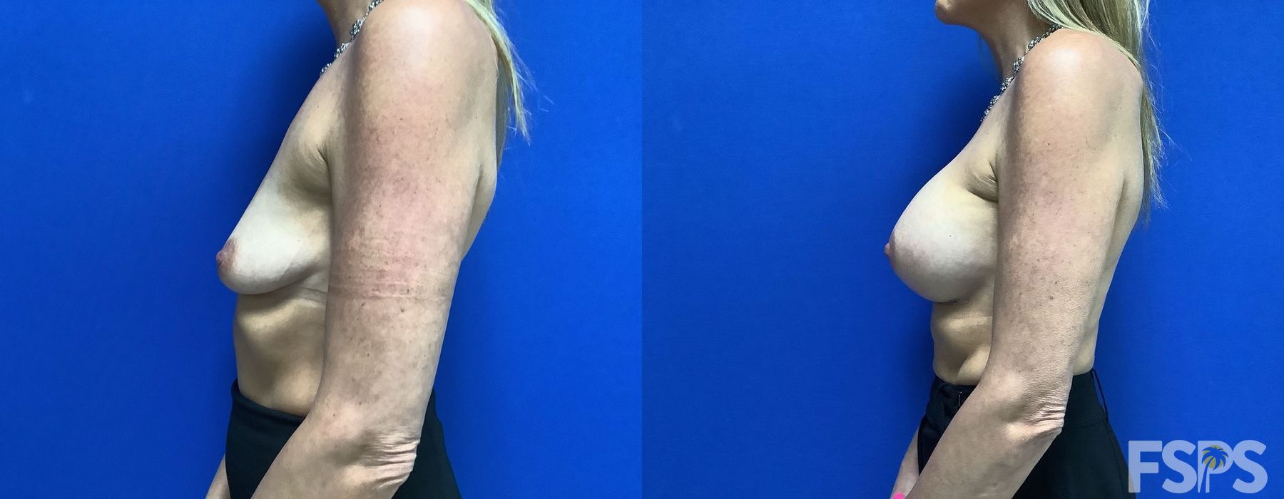 Before and after Breast Augmentation case 17712 - Angle 3