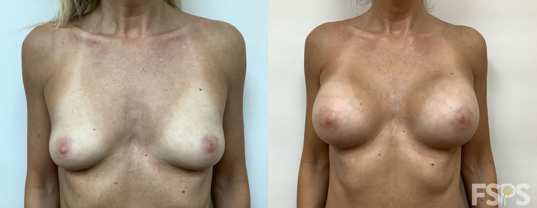 Breast Augmentation - Case 22781