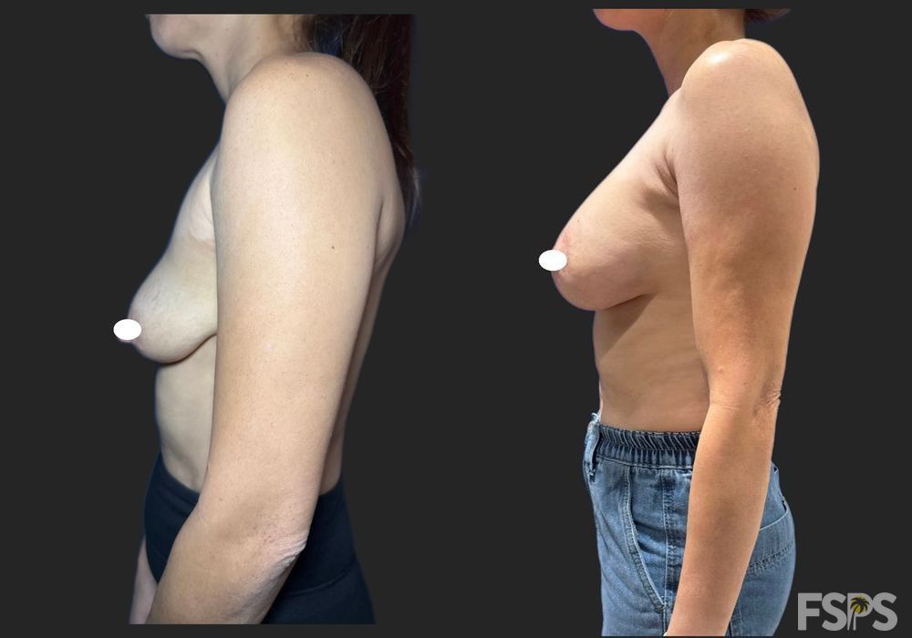 Breast Lift - Thumbnail 3