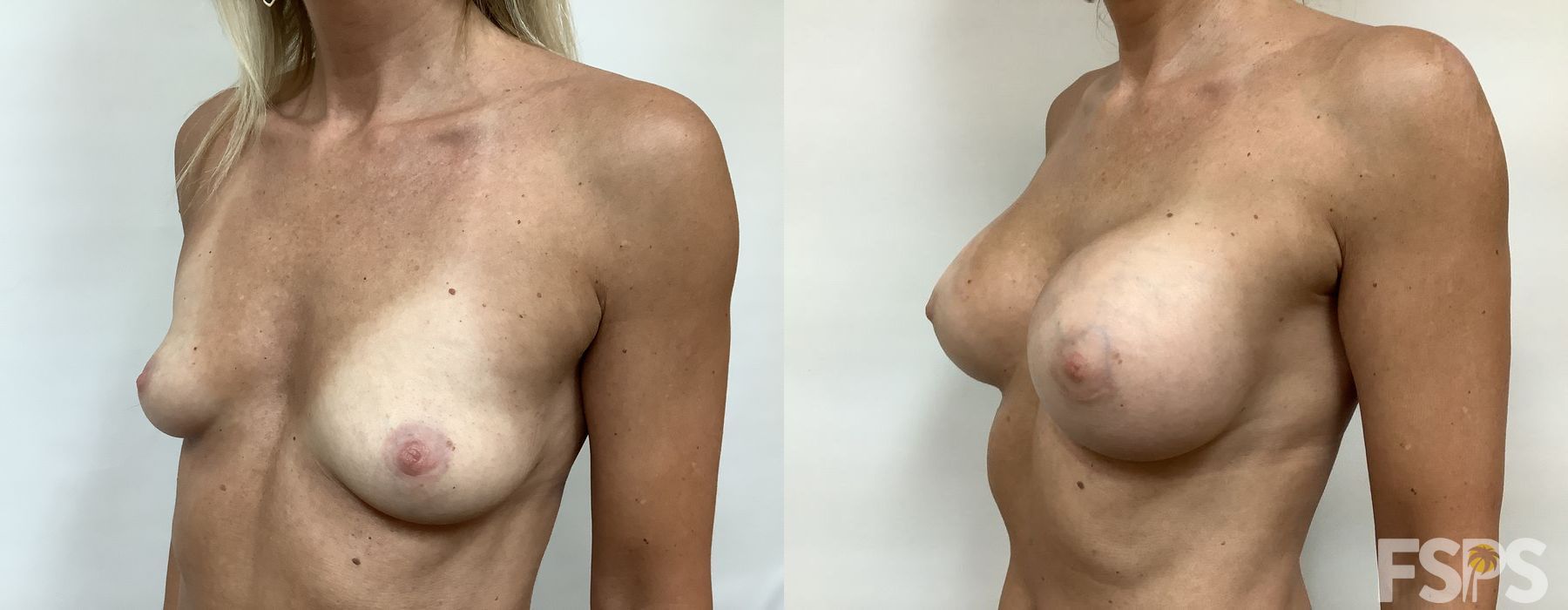 Breast Augmentation - Thumbnail 2