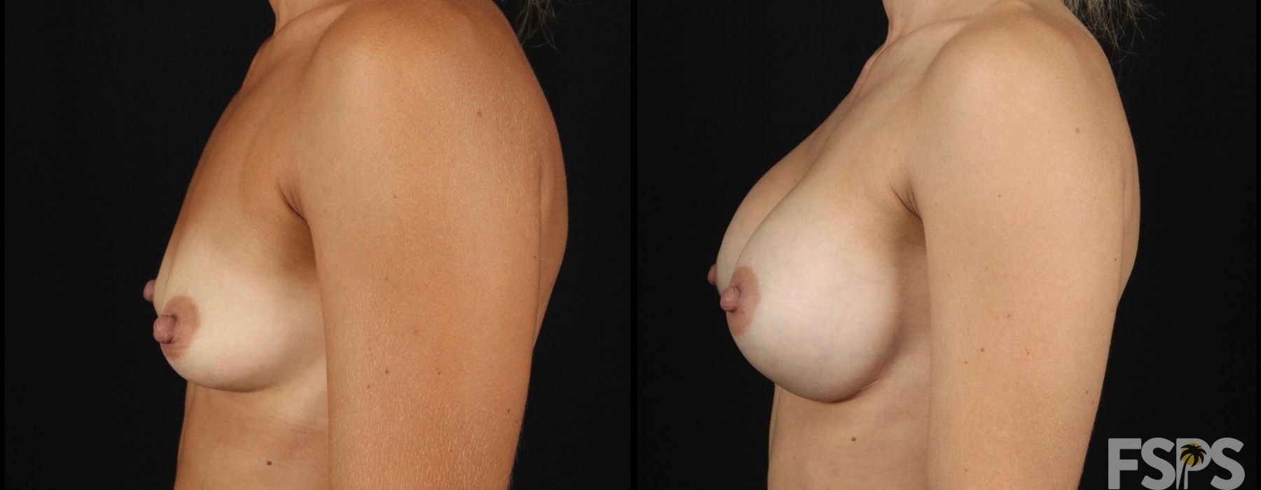 Breast Augmentation - Thumbnail 3