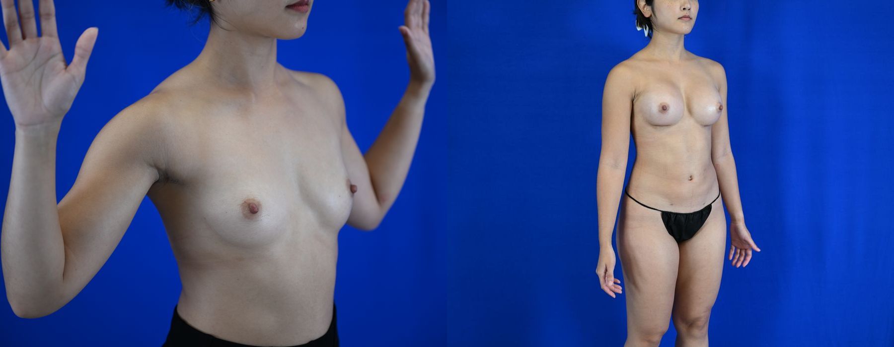 Breast Augmentation - Thumbnail 4