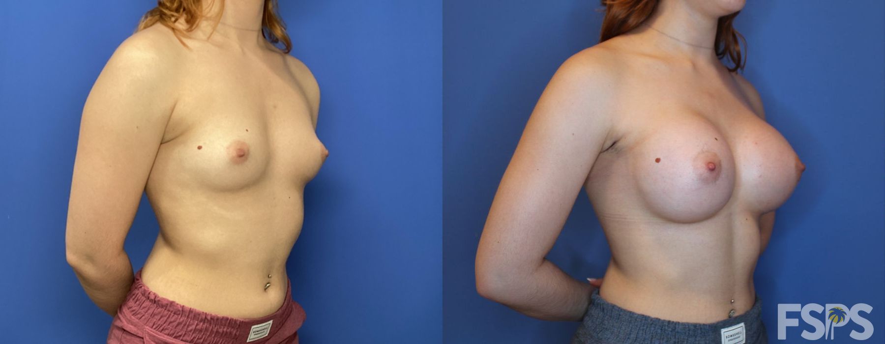 Before and after Breast Augmentation case 17618 - Angle 2