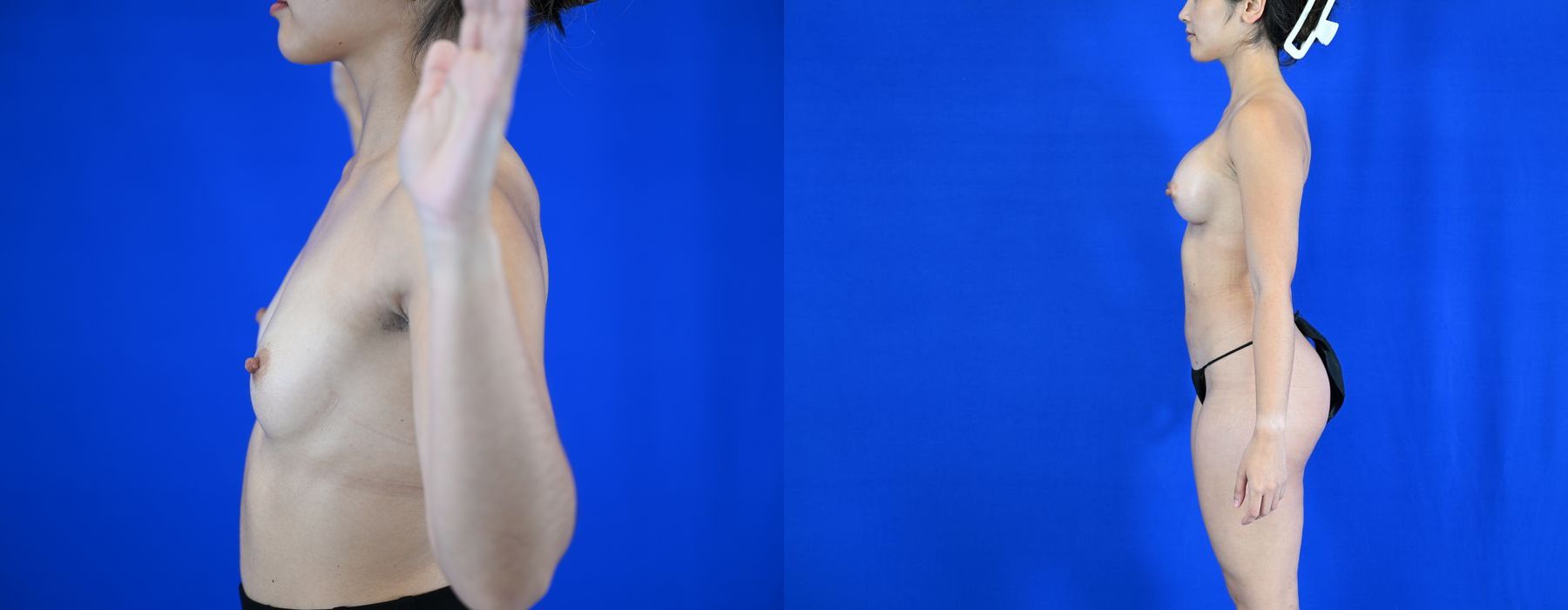 Breast Augmentation - Thumbnail 3