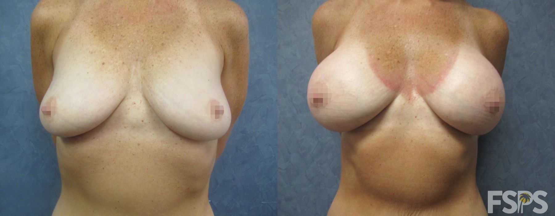 Breast Augmentation - Case 22943