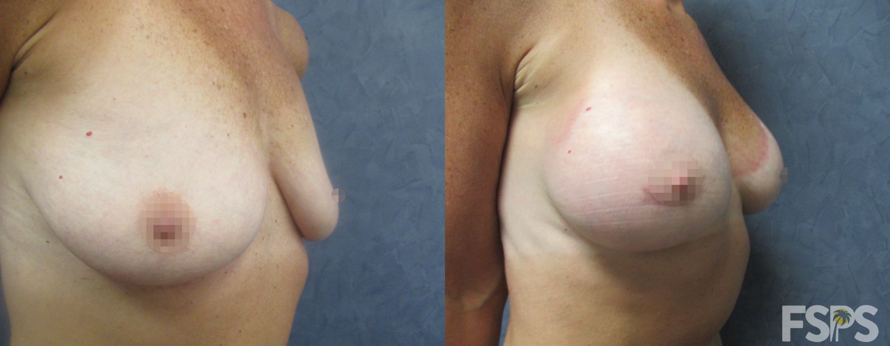 Breast Augmentation - Thumbnail 3