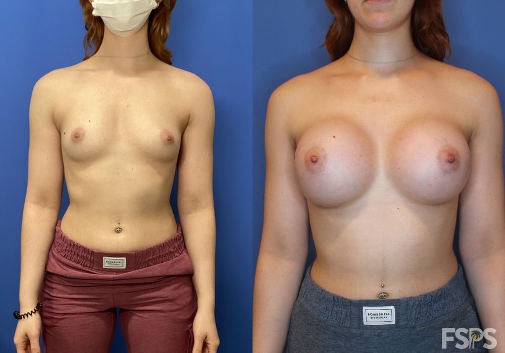 Before and after Breast Augmentation case 17618