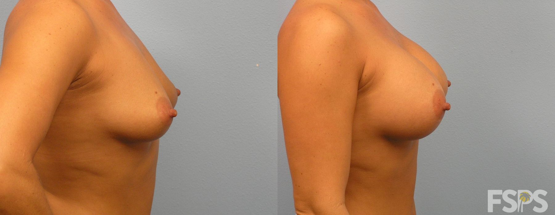 Breast Augmentation - Thumbnail 3