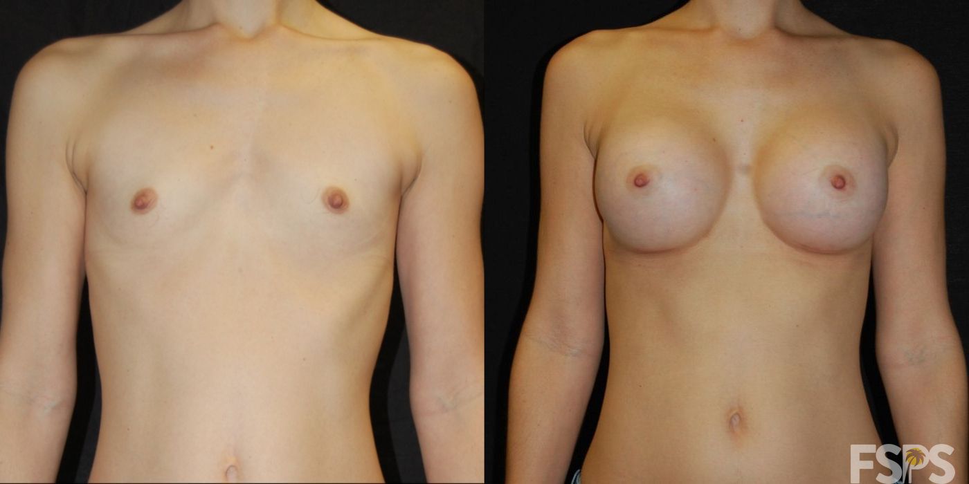 Breast Augmentation - Case 22768