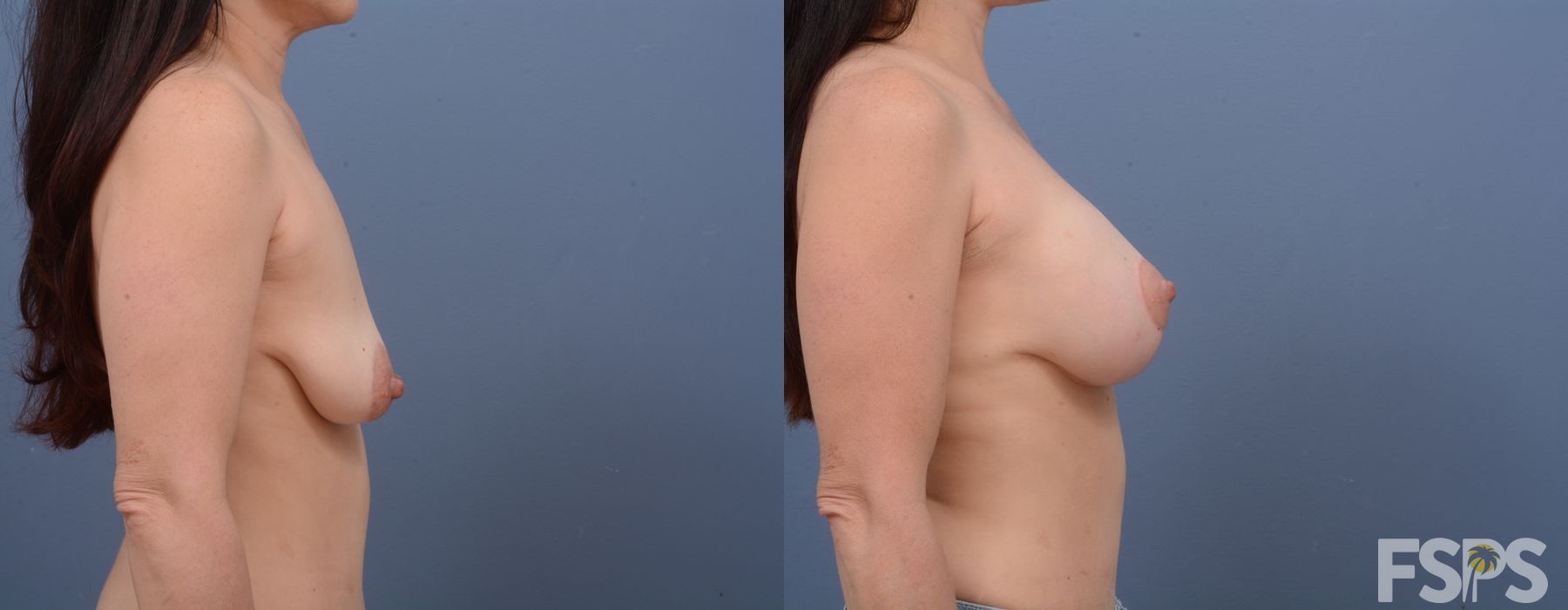 Breast Lift - Thumbnail 2