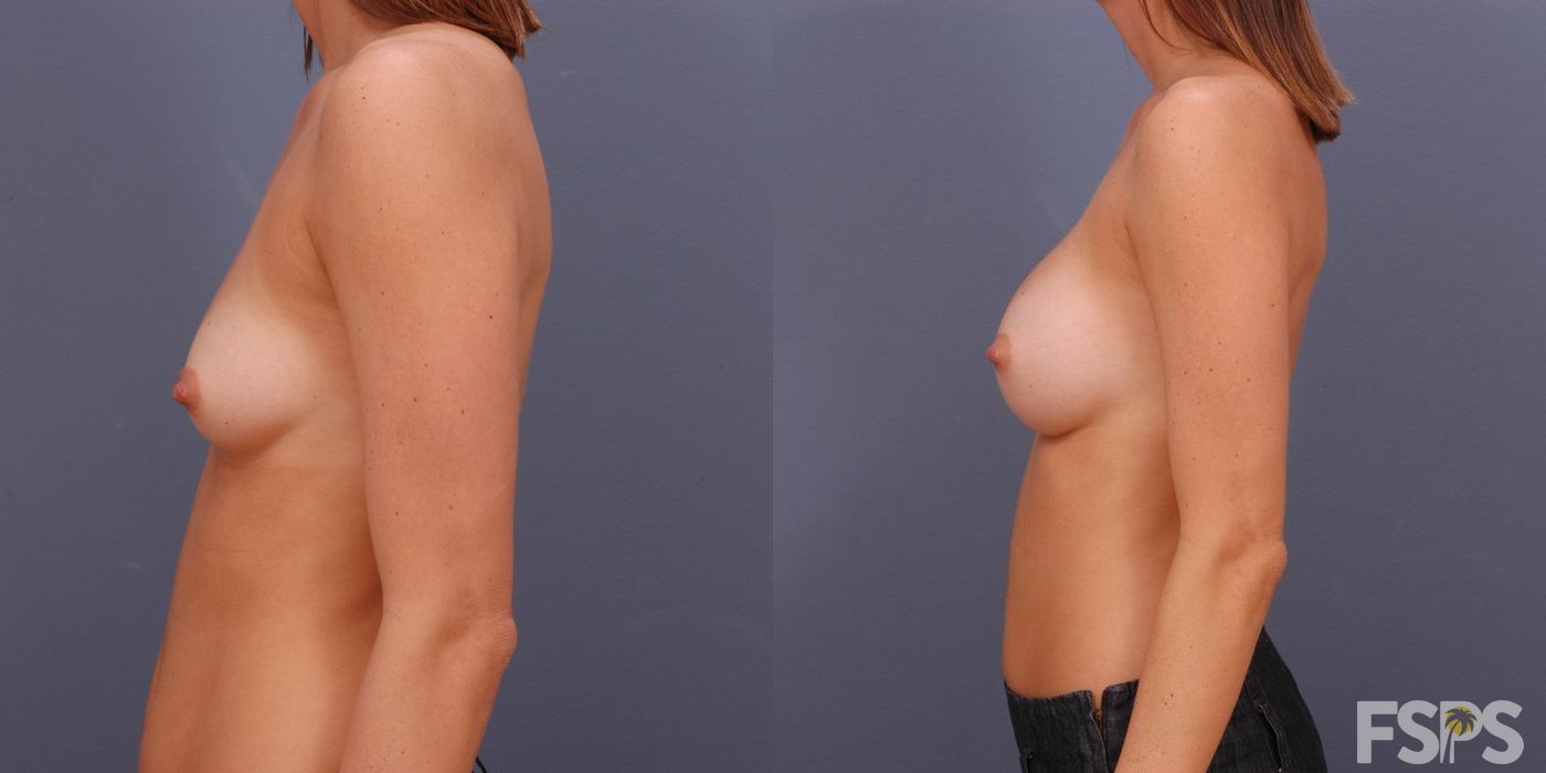 Breast Augmentation - Thumbnail 4