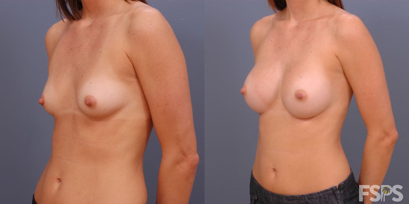 Breast Augmentation - Thumbnail 5