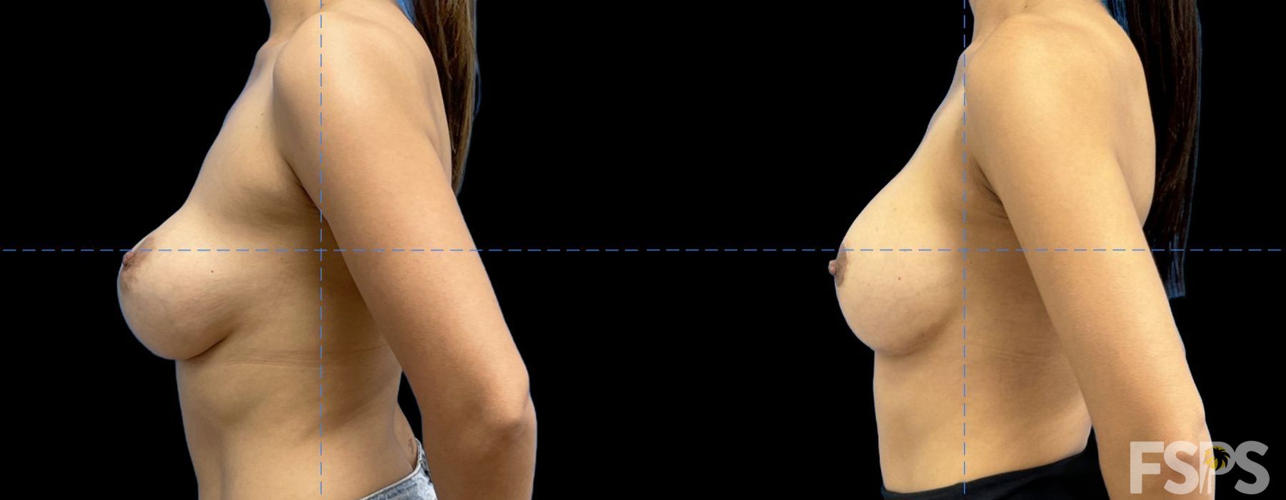 Breast Augmentation with Lift - Thumbnail 2