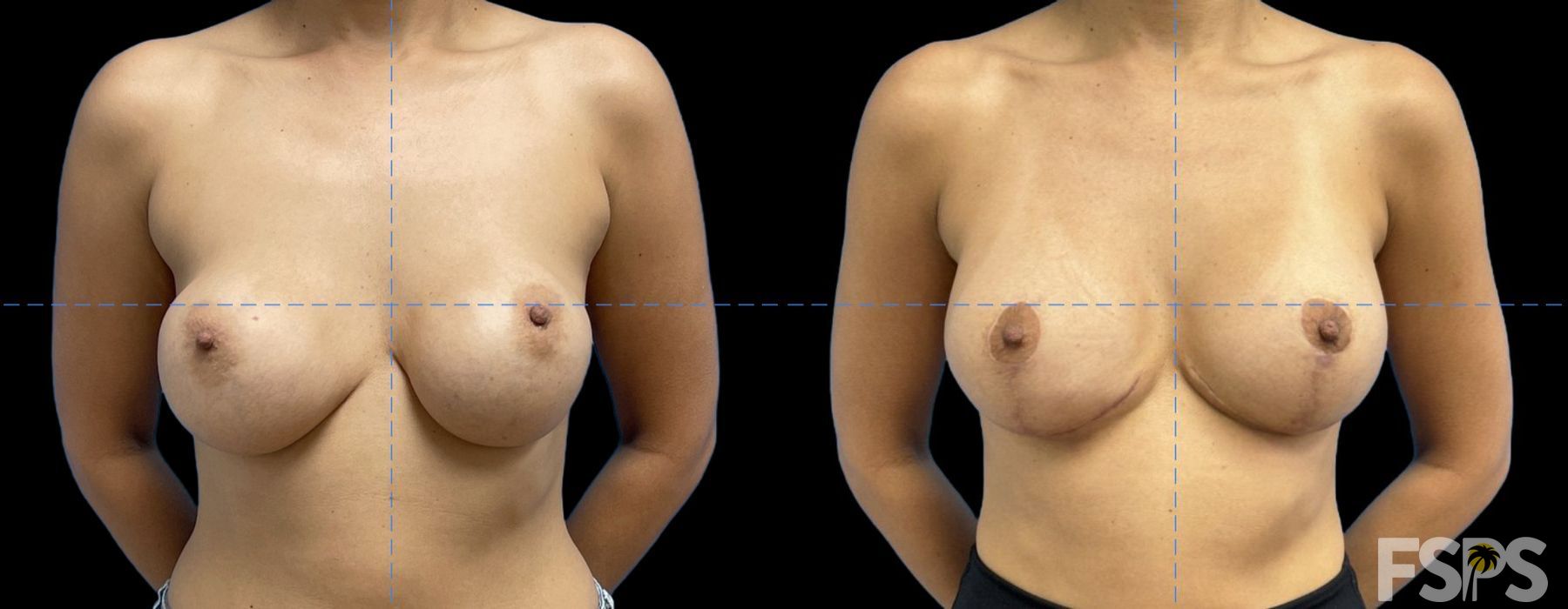 Breast Augmentation with Lift - Case 22951